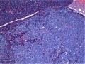 Oncology